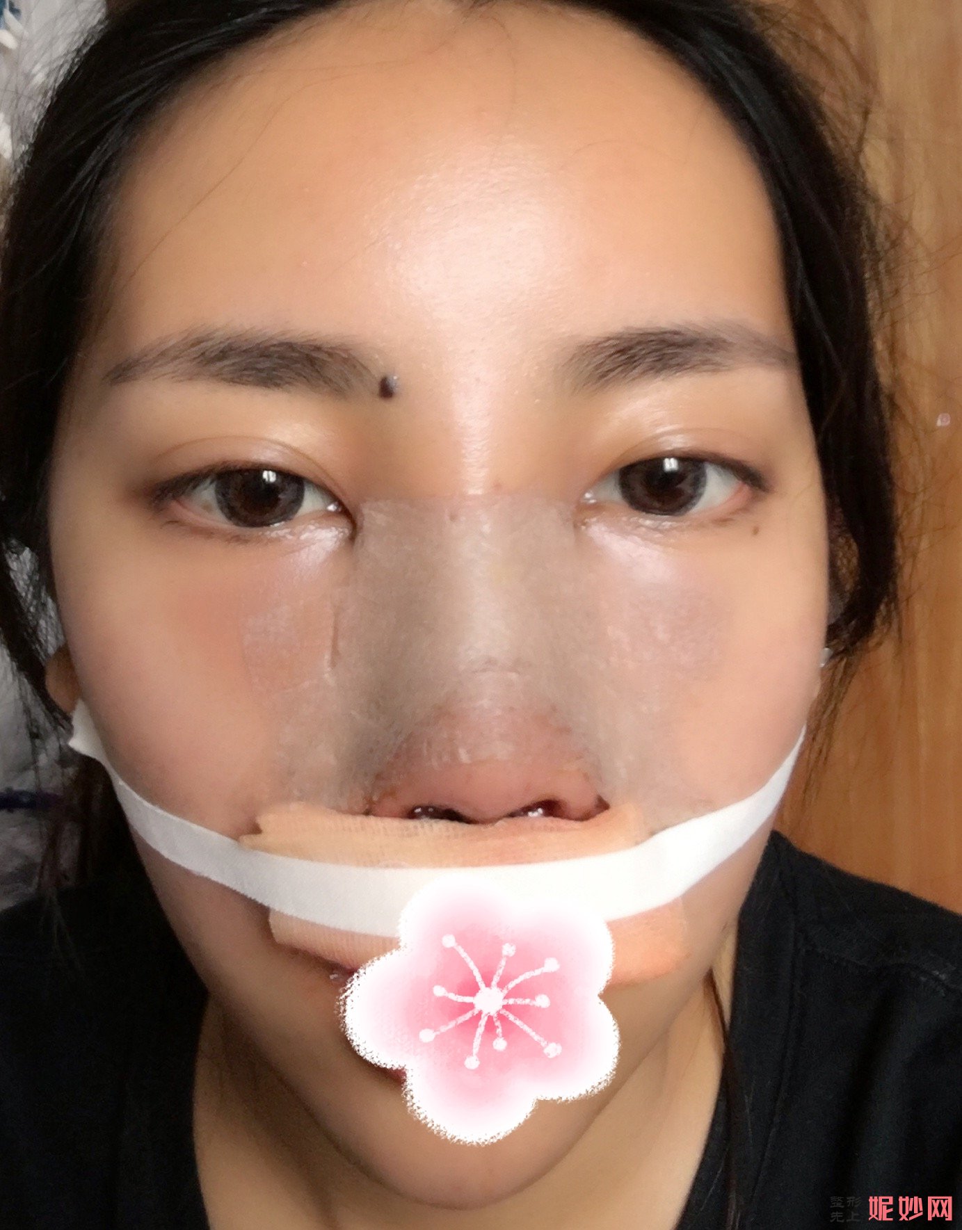 北京西美斯医疗美容耳软骨隆鼻费用多少钱？