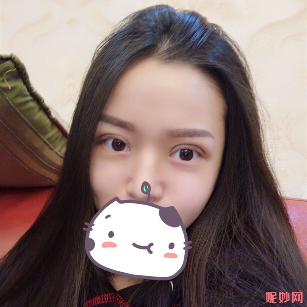 成都市西区医院整形美容科段焘双眼皮效果怎么样？术后效果非常自然呢！