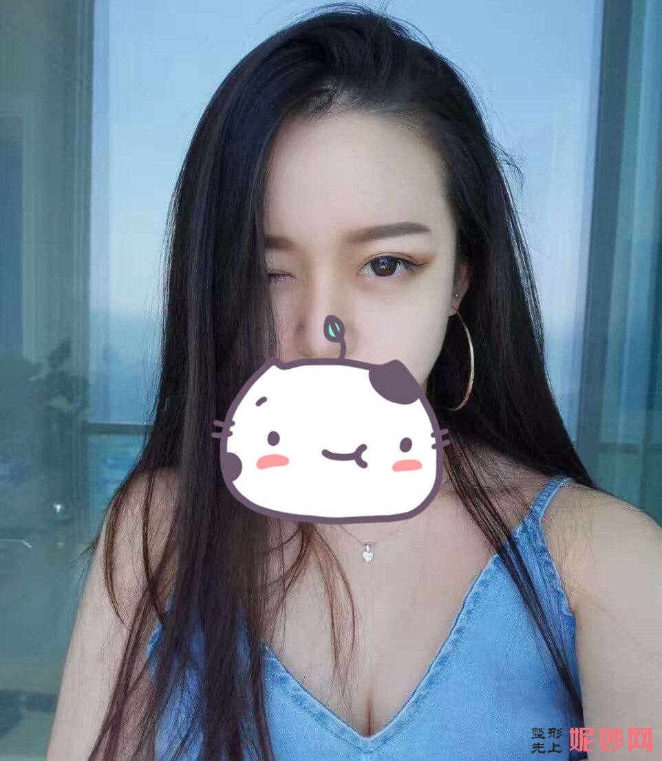 成都市西区医院整形美容科段焘双眼皮效果怎么样？术后效果非常自然呢！