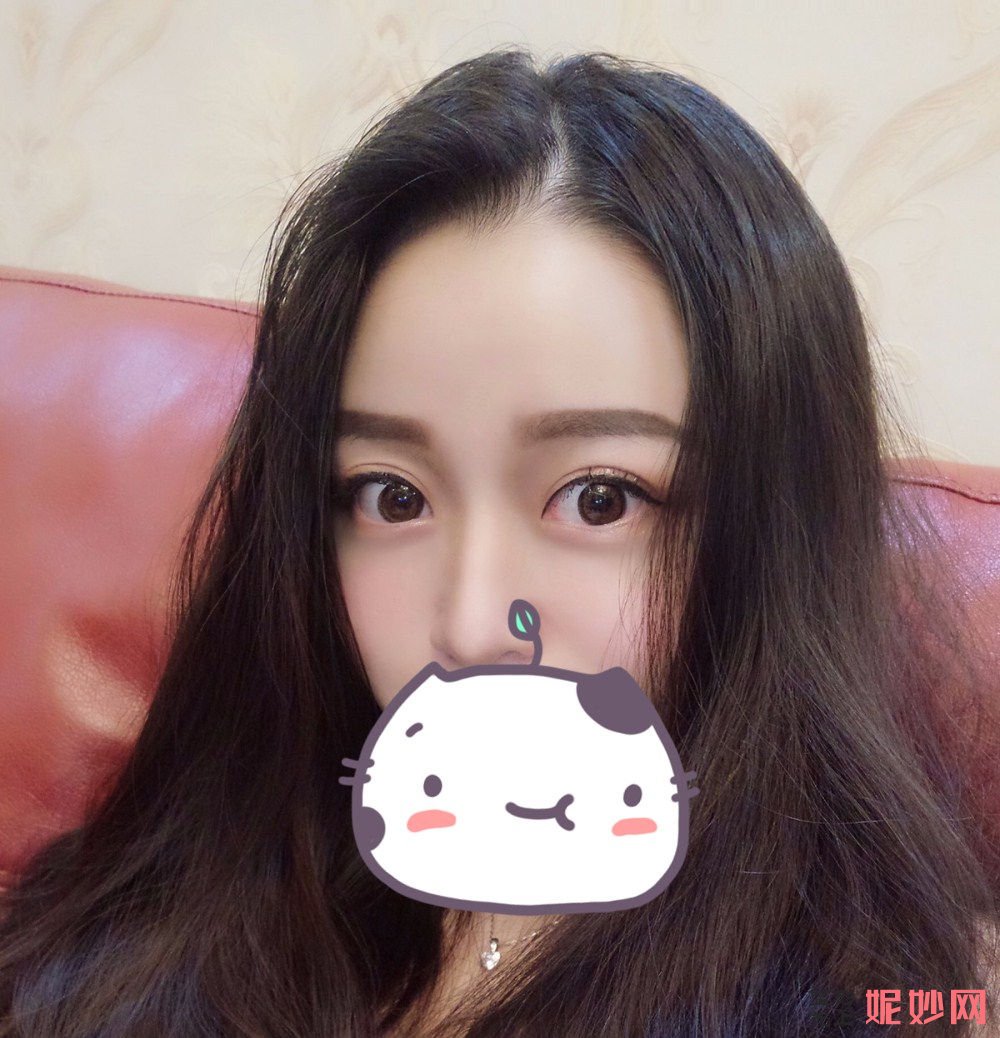 成都市西区医院整形美容科段焘双眼皮效果怎么样？术后效果非常自然呢！