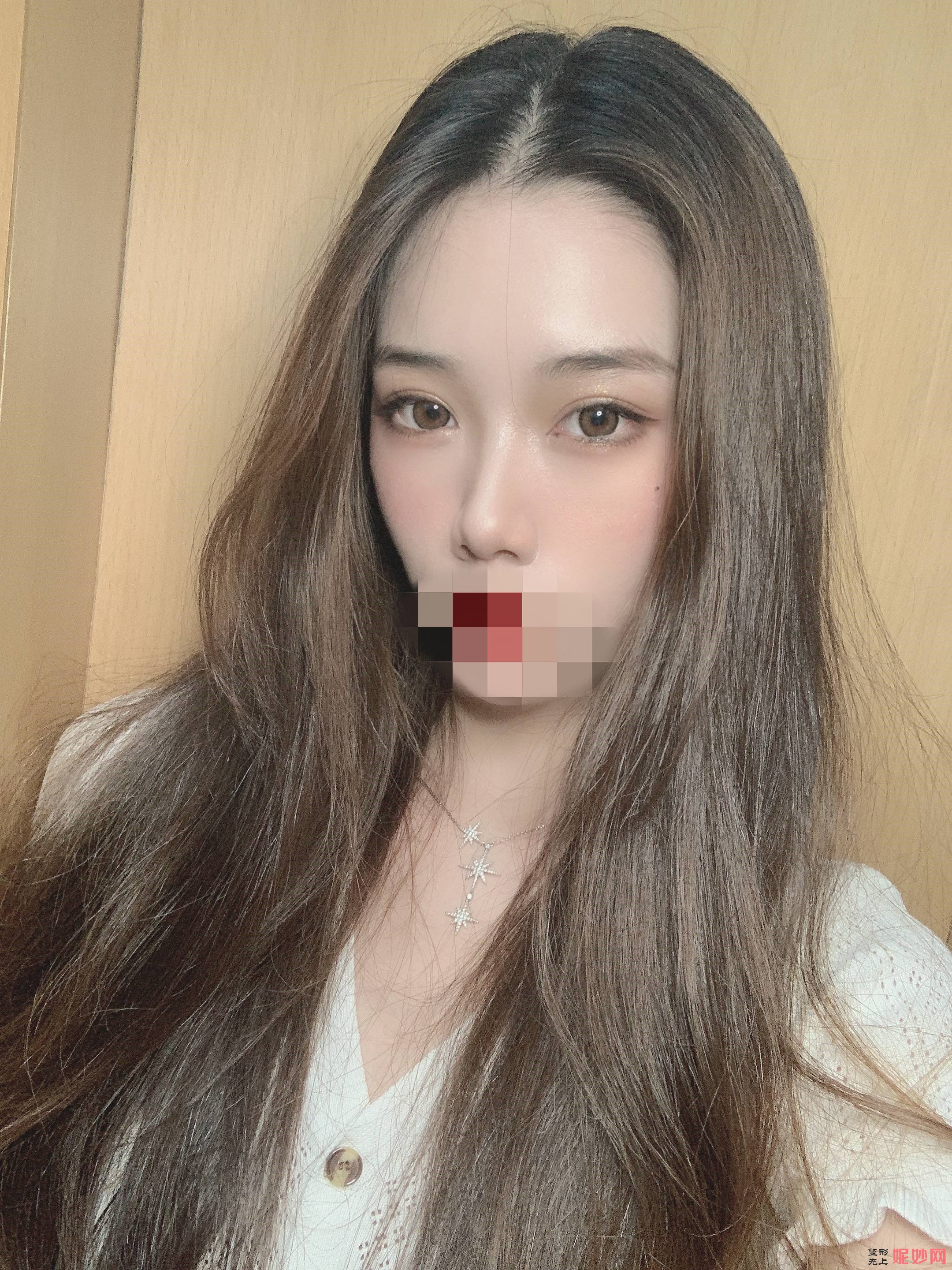 成都市西区医院整形美容科颜子云做双眼皮怎么样？让我眼睛从此好看起来了！