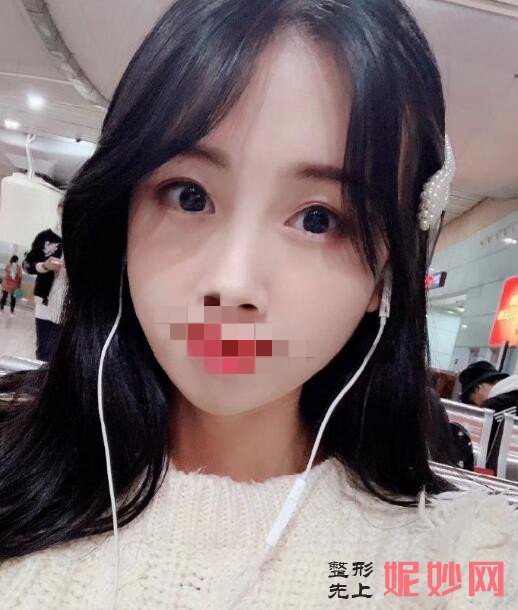 成都市西区医院整形美容科颜子云做隆鼻怎么样？让我的鼻子从此有了高鼻梁！