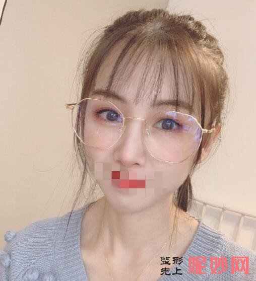 成都市西区医院整形美容科颜子云做隆鼻怎么样？让我的鼻子从此有了高鼻梁！