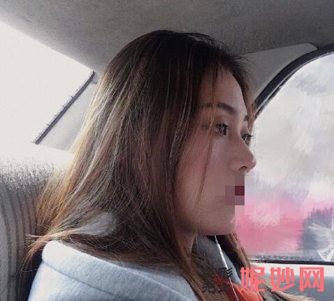 成都市西区医院整形美容科黄富伟做隆鼻手术效果怎么样啊？效果非常自然！