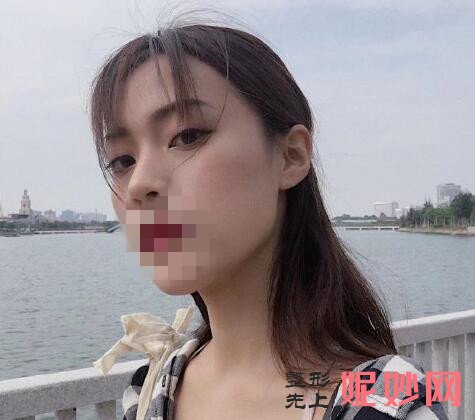 成都市西区医院整形美容科黄富伟做隆鼻手术效果怎么样啊？效果非常自然！