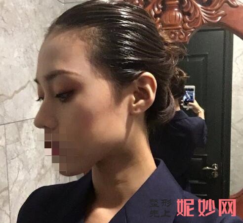 成都市西区医院整形美容科黄富伟做隆鼻手术效果怎么样啊？效果非常自然！