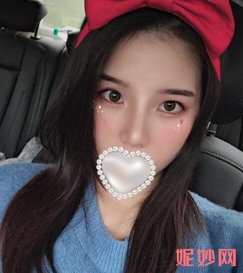 成都市西区医院整形美容科黄富伟做隆鼻修复手术怎么样？让我之前失败的隆鼻又好起来了！