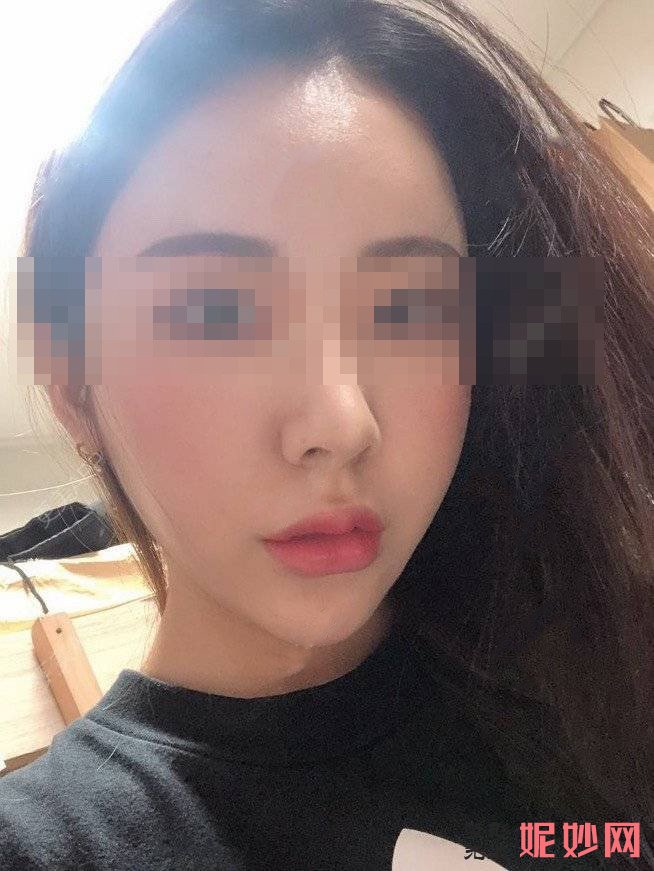 成都市西区医院整形美容科黄富伟做面部填充做怎么样？让我的脸部又年轻起来了！