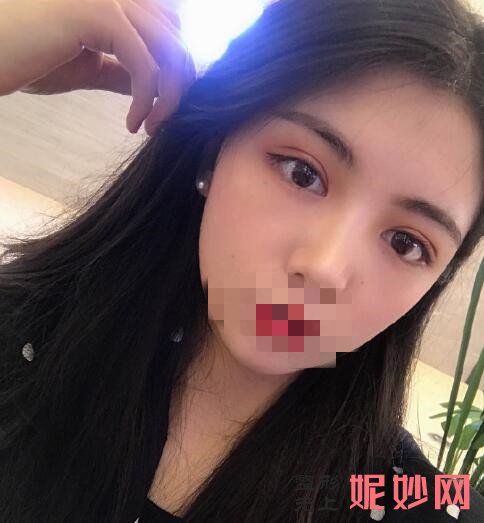 成都市西区医院整形美容科陈鸿双眼皮怎么样啊？效果非常的好！