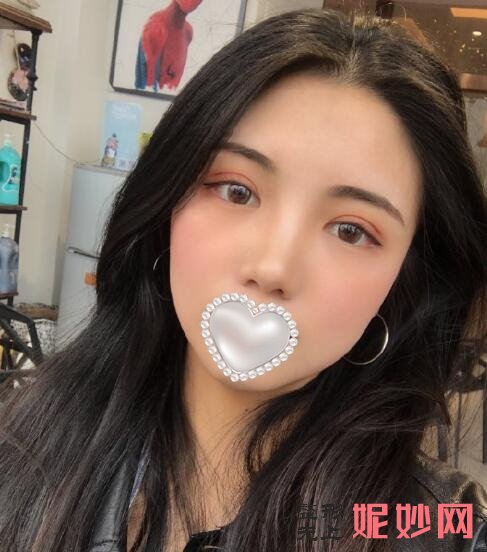 成都市西区医院整形美容科陈鸿双眼皮怎么样啊？效果非常的好！