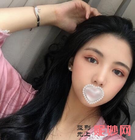 成都市西区医院整形美容科陈鸿双眼皮怎么样啊？效果非常的好！