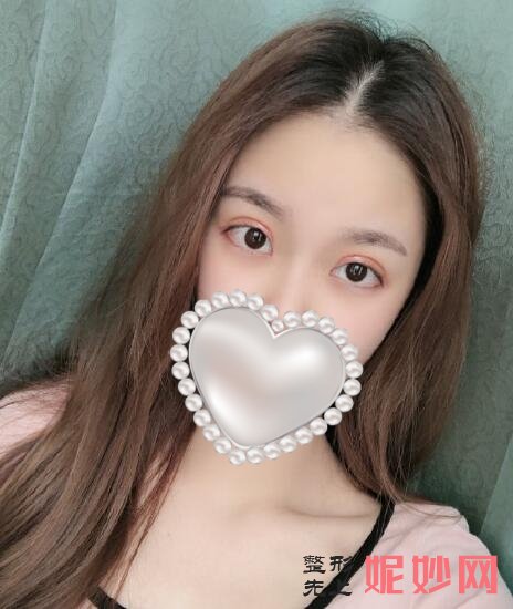 成都市西区医院整形美容科车红昌做双眼皮怎么样？让我从此自信起来了！