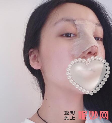 成都市西区医院整形美容科车红昌隆鼻怎么样？让我的鼻子非常自然了！