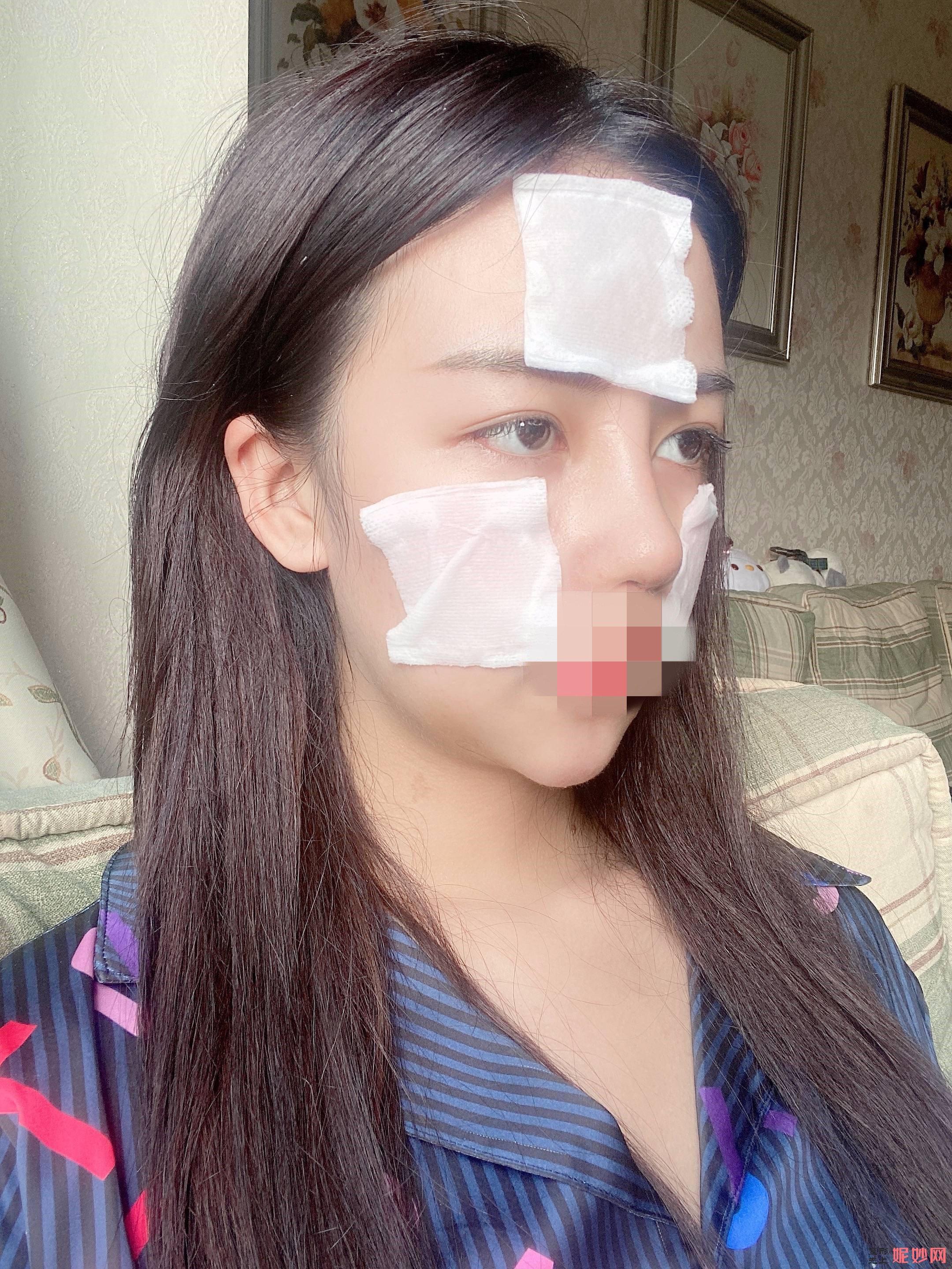 成都市西区医院整形美容科邓东伟隆鼻手术怎么样？让我的鼻子挺立起来！