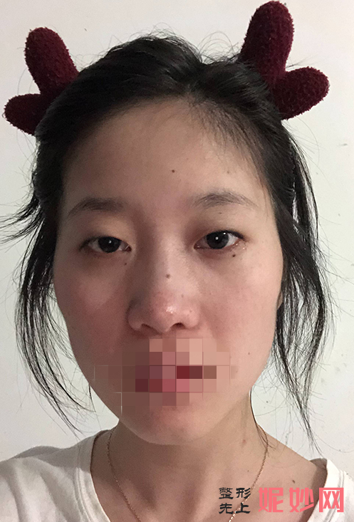 成都市西区医院整形美容科邓东伟双眼皮做得怎么样？让我有了双眼皮，让我的眼睛更加好看了！