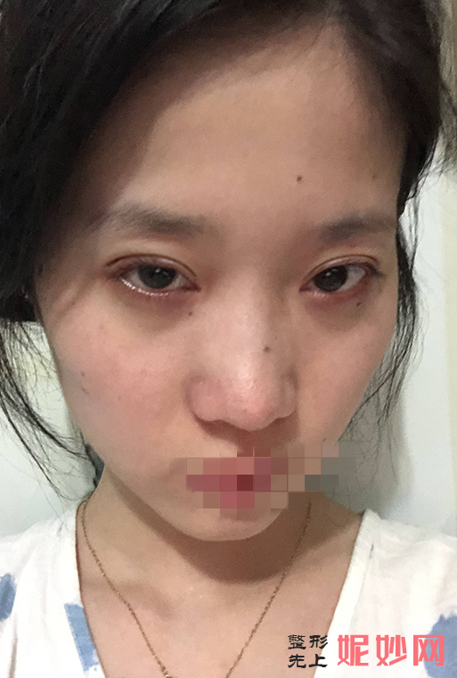 成都市西区医院整形美容科邓东伟双眼皮做得怎么样？让我有了双眼皮，让我的眼睛更加好看了！