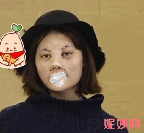 成都市西区医院整形美容科邓东伟隆鼻效果怎么样？效果非常好！