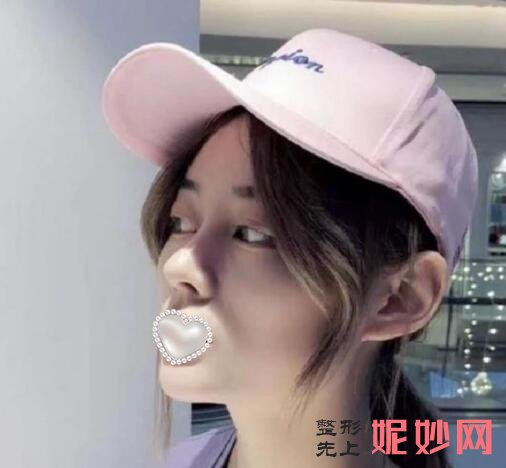 成都市西区医院整形美容科邓东伟隆鼻效果怎么样？效果非常好！
