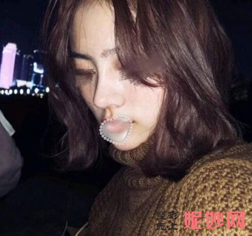 成都市西区医院整形美容科邓东伟隆鼻效果怎么样？效果非常好！