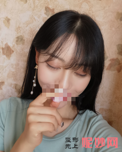 成都市西区医院整形美容科宋华敬面部填充怎么样？让我的大脸变小脸了！