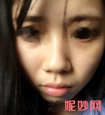 武汉美基元整形医院汪福强自体软肋骨隆鼻好吗？追求自然的高级立体感！