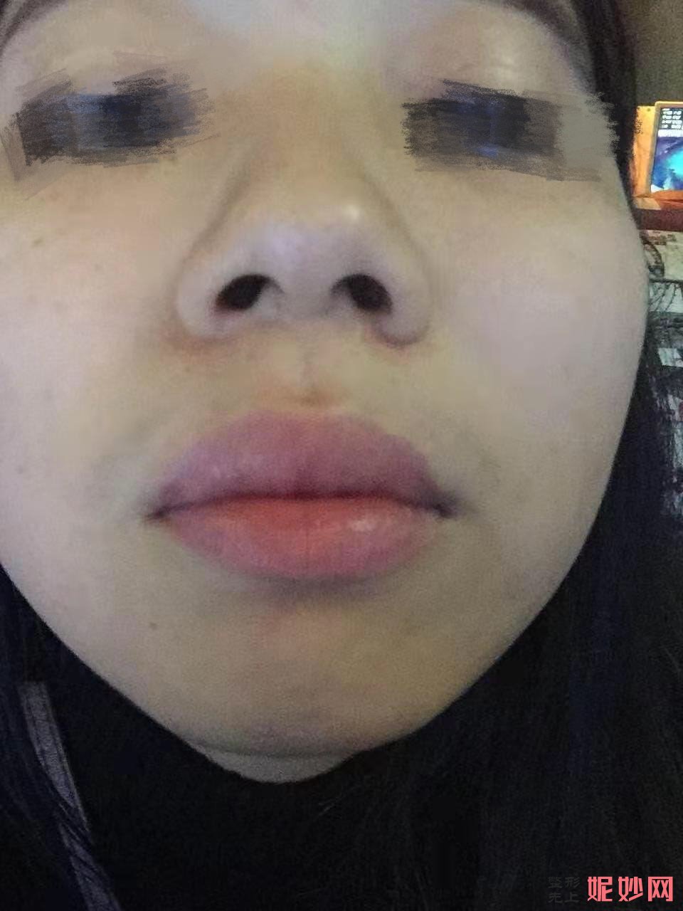 武汉美基元整形医院汪福强自体软肋骨隆鼻好吗？追求自然的高级立体感！