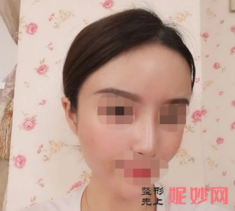 成都鹏爱悦己医疗美容门诊部赵普阳线雕效果如何？年轻好几岁，让人羡慕！