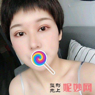 成都鹏爱悦己医疗美容门诊部陈文海双眼皮做得怎么样？眼睛瞬间放大，有神又明亮！