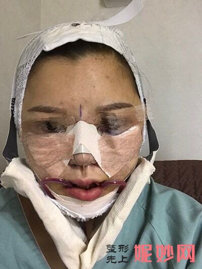 成都鹏爱悦己医疗美容门诊部黄富伟隆鼻做的好吗？立体又挺翘，脸都变精致了！