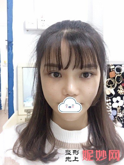 成都鹏爱悦己医疗美容门诊部黄富伟隆鼻做的好吗？立体又挺翘，脸都变精致了！