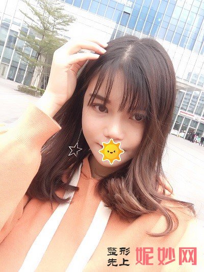 成都鹏爱悦己医疗美容门诊部黄富伟隆鼻做的好吗？立体又挺翘，脸都变精致了！