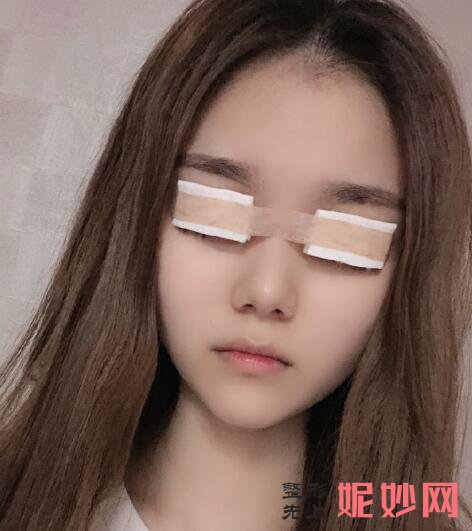 成都鹏爱悦己医疗美容门诊部黄富伟双眼皮做得怎么样？眼睛又大又明亮，太好看了！