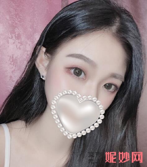 成都鹏爱悦己医疗美容门诊部黄富伟双眼皮做得怎么样？眼睛又大又明亮，太好看了！