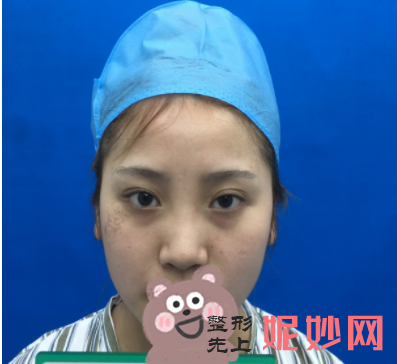 黄富伟做鼻子怎么样？