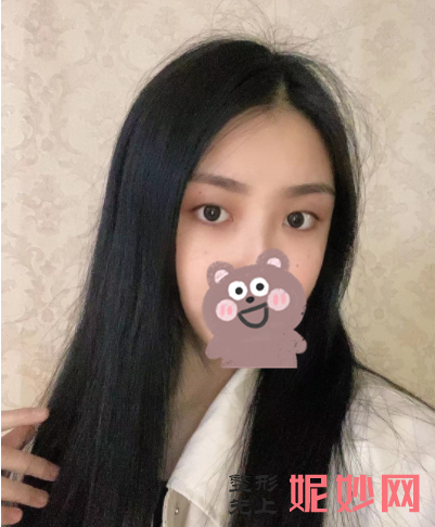 黄富伟做双眼皮怎么样？
