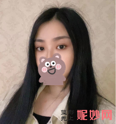 黄富伟做双眼皮怎么样？