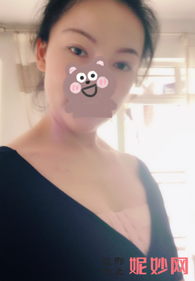 宋华敬做填充怎么样？