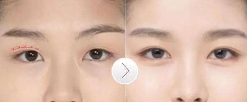 割双眼皮有什么危害或者后遗症？求相关人士介绍