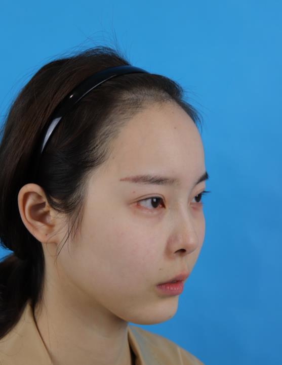 温州加美整形美容医院假体隆鼻和鼻头缩小技术如何？