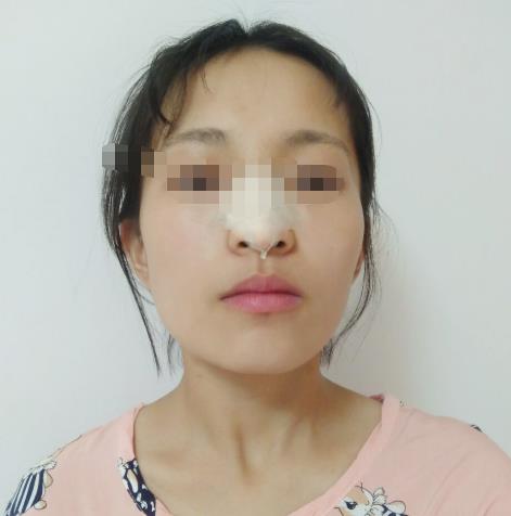 玻尿酸隆鼻子可以维持多久，案例分享!