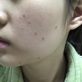 激光点痣后注意事项有哪些