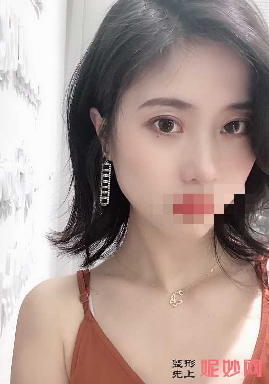 北京大学深圳医院崔永言双眼皮案例怎么样？术后真的是太自然了！