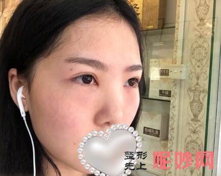 北京大学深圳医院崔永言祛眼袋怎么样？让我从此告别了两个熊猫眼了！