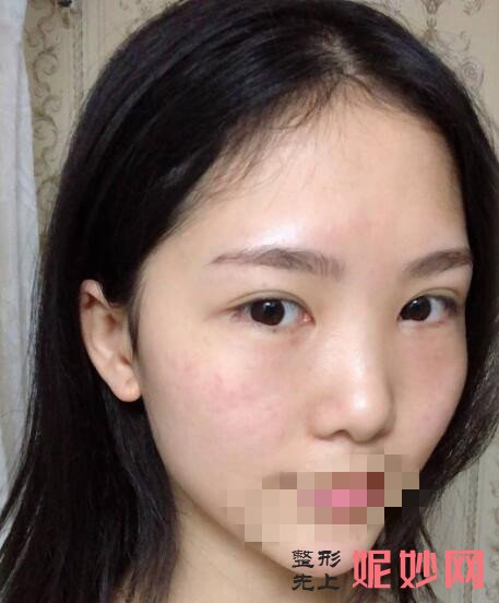 北京大学深圳医院崔永言祛眼袋怎么样？让我从此告别了两个熊猫眼了！