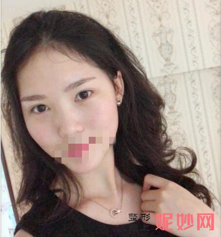 北京大学深圳医院崔永言祛眼袋怎么样？让我从此告别了两个熊猫眼了！