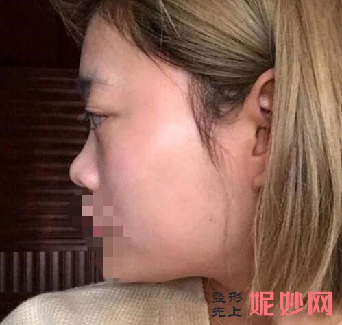 北大崔永言鼻综合案例？让我拥有了挺立的鼻子了！