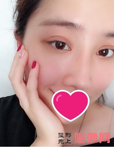 深圳北大崔永言隆鼻如何？术后效果真的太美啦快来康康吧_附隆鼻前后照片对比图