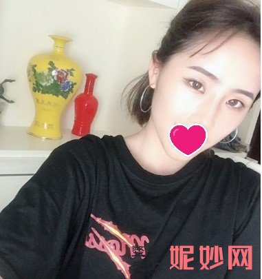 深圳北大崔永言隆鼻如何？术后效果真的太美啦快来康康吧_附隆鼻前后照片对比图