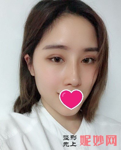 深圳北大崔永言隆鼻如何？术后效果真的太美啦快来康康吧_附隆鼻前后照片对比图