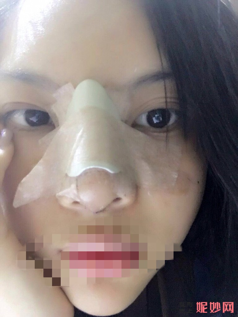 北大崔永言做鼻翼缩小怎么样？附鼻翼缩小前后效果图+2021较新价格表